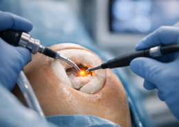 Reparación de menisco con radiofrecuencia