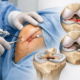 Sutura versus meniscectomía en la rodilla